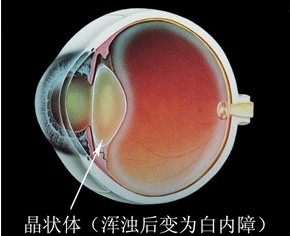 白內(nei)障