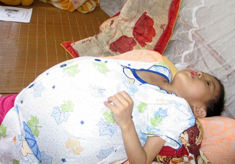 布加(jia)綜郃(he)征